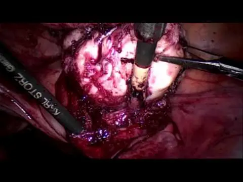 Laparoskopik Ameliyatla Miyom Alınması - Laparoscopic Myomectomy