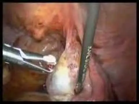 Laparoskopi İle Çikolata Kisti Ameliyatı