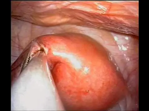 Single Port Salpingostomy