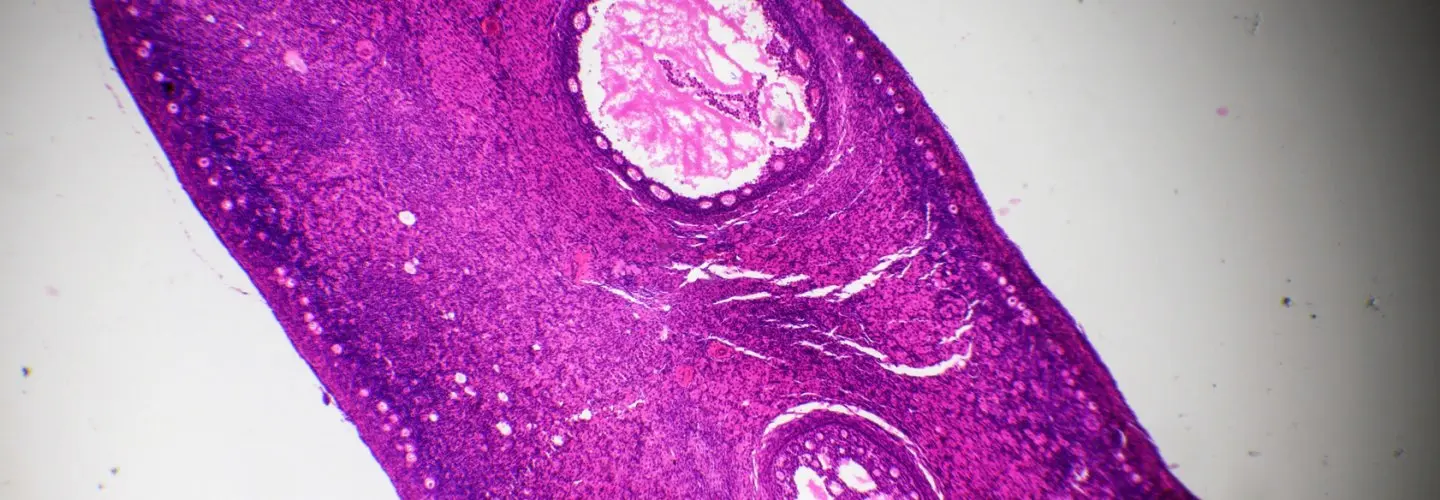Polikistik Over Sendromu nedenleri ve tedavisi